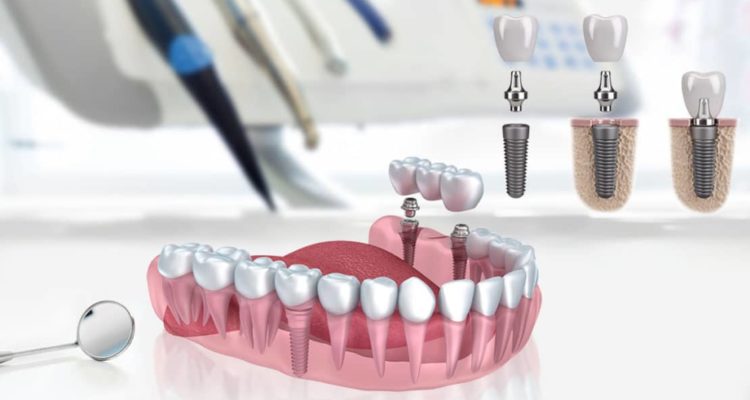 prix-implants-dentaires-tunisie
