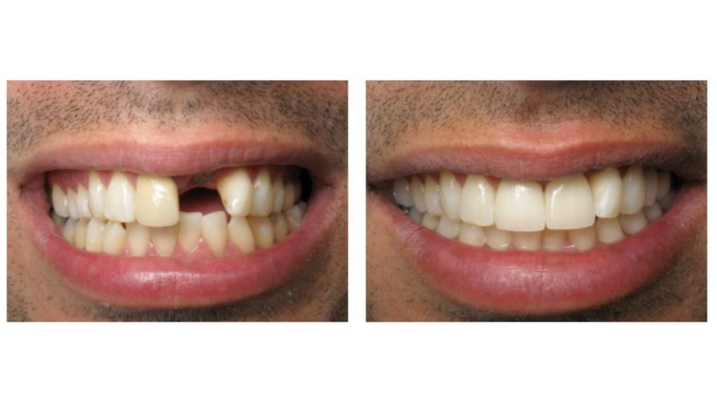 resultat-pose-implant-dentaire-avant-apres